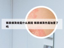 银屑病发烧是什么原因 银屑病发热是加重了吗