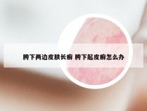 胯下两边皮肤长癣 胯下起皮癣怎么办