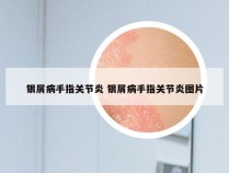 银屑病手指关节炎 银屑病手指关节炎图片