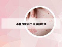 手背白斑治疗 手背部白斑