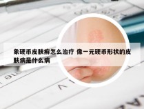 象硬币皮肤癣怎么治疗 像一元硬币形状的皮肤病是什么病