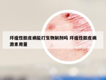 坏疽性脓皮病能打生物制剂吗 坏疽性脓皮病激素用量