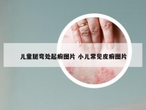 儿童腿弯处起癣图片 小儿常见皮癣图片