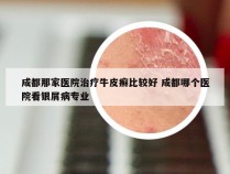 成都那家医院治疗牛皮癣比较好 成都哪个医院看银屑病专业