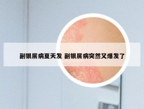 副银屑病夏天发 副银屑病突然又爆发了