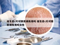 维生素c片对银屑病有用吗 维生素c片对银屑病有用吗女性