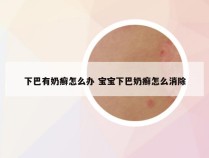 下巴有奶癣怎么办 宝宝下巴奶癣怎么消除