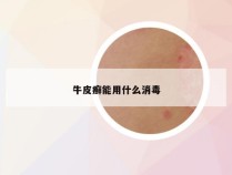 牛皮癣能用什么消毒