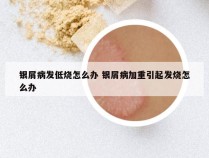 银屑病发低烧怎么办 银屑病加重引起发烧怎么办