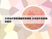 兰州治疗银屑病医院有哪些 兰州治疗皮肤病的医院