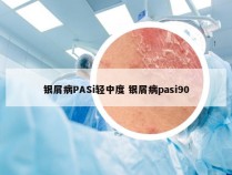 银屑病PASi轻中度 银屑病pasi90