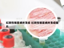 红斑性银屑病并发症 红斑性银屑病并发症图片