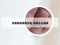 皮癣是啥原因引起 皮癣怎么回事