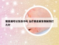 银屑病可以生孩子吗 治疗银皮癣生物制剂打几针