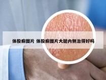 体股癣图片 体股癣图片大腿内侧治得好吗