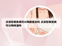 点滴型银屑病可以喝蜂蜜水吗 点滴型银屑病可以喝啤酒吗