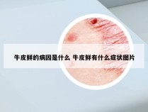 牛皮鲜的病因是什么 牛皮鲜有什么症状图片