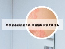 银屑病手部面部长吗 银屑病长手掌上叫什么