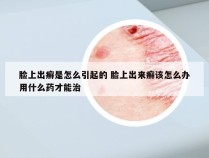 脸上出癣是怎么引起的 脸上出来癣该怎么办用什么药才能治