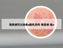 银屑病可以抹维a酸乳膏吗 银屑病 维a