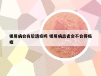 银屑病会有后遗症吗 银屑病患者会不会得癌症