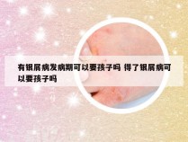 有银屑病发病期可以要孩子吗 得了银屑病可以要孩子吗