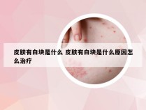 皮肤有白块是什么 皮肤有白块是什么原因怎么治疗