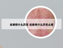 皮癣擦什么药膏 皮癣用什么药膏止痒