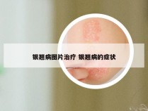 银翘病图片治疗 银翘病的症状