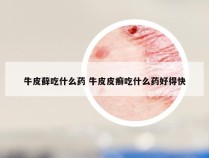 牛皮藓吃什么药 牛皮皮癣吃什么药好得快