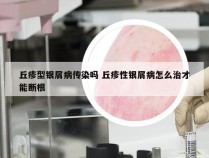 丘疹型银屑病传染吗 丘疹性银屑病怎么治才能断根