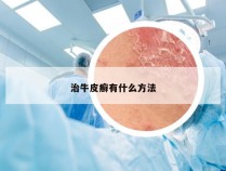 治牛皮癣有什么方法