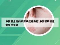 中国最全面的银屑病统计数据 中国银屑病患者生存实录