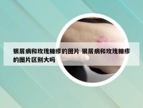 银屑病和玫瑰糠疹的图片 银屑病和玫瑰糠疹的图片区别大吗