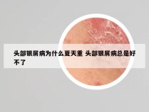 头部银屑病为什么夏天重 头部银屑病总是好不了