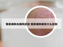 银屑病和白癜风区别 银屑病和癣有什么区别