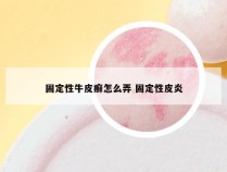 固定性牛皮癣怎么弄 固定性皮炎