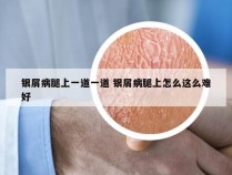 银屑病腿上一道一道 银屑病腿上怎么这么难好