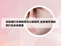 皮肤病打生物制剂可以报销吗 皮肤病生物制剂打在身体哪里