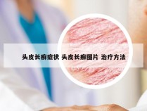 头皮长癣症状 头皮长癣图片 治疗方法