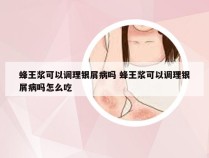 蜂王浆可以调理银屑病吗 蜂王浆可以调理银屑病吗怎么吃