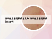 孩子身上老是长癣怎么办 孩子身上老是长癣怎么办啊