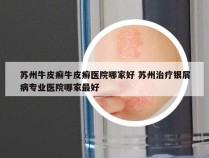 苏州牛皮癣牛皮癣医院哪家好 苏州治疗银屑病专业医院哪家最好