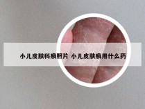 小儿皮肤科癣照片 小儿皮肤癣用什么药