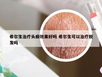 希尔生治疗头癣效果好吗 希尔生可以治疗脱发吗