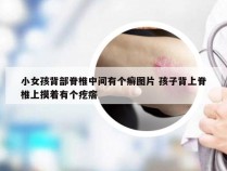 小女孩背部脊椎中间有个癣图片 孩子背上脊椎上摸着有个疙瘩