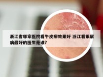 浙江省哪家医院看牛皮癣效果好 浙江看银屑病最好的医生是谁?