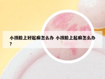 小孩脸上好起癣怎么办 小孩脸上起癣怎么办?