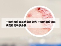 干细胞治疗银屑病费用高吗 干细胞治疗银屑病费用高吗多少钱