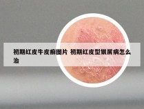 初期红皮牛皮癣图片 初期红皮型银屑病怎么治